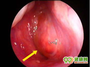 鼻咽纤维血管瘤