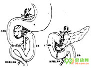 肠系膜上动脉综合征